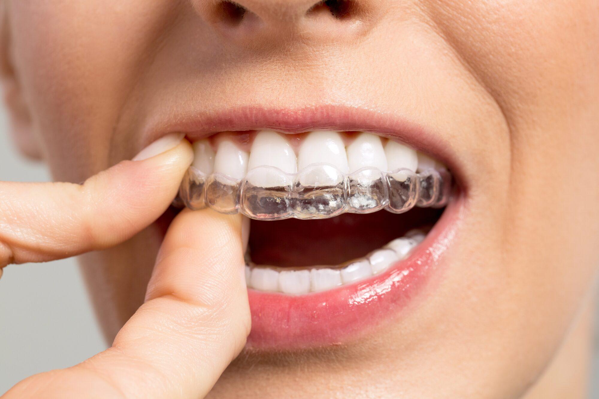 Close-up of a clear aligner fitted over the teeth