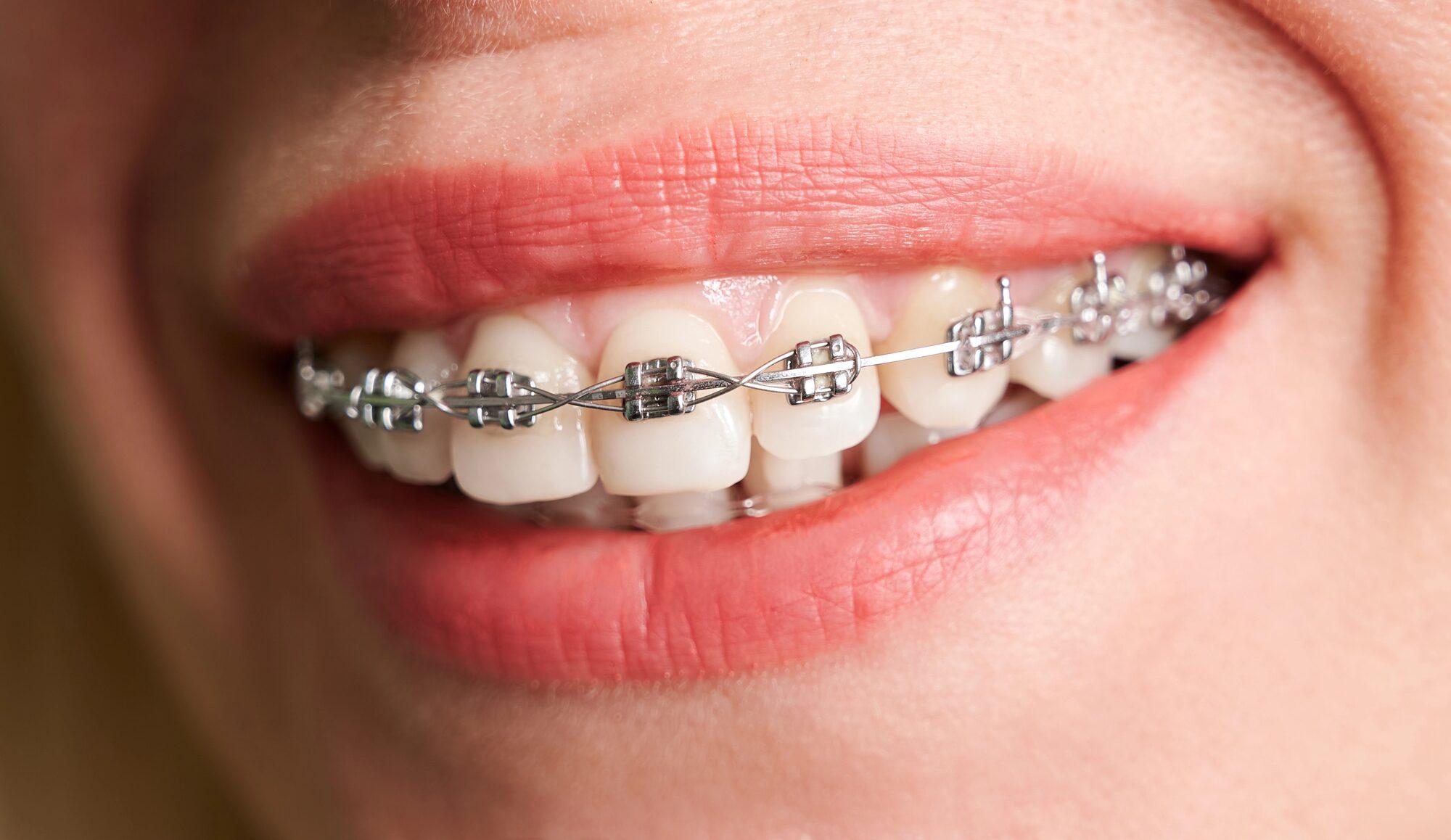 Orthodontics for children & teenagers