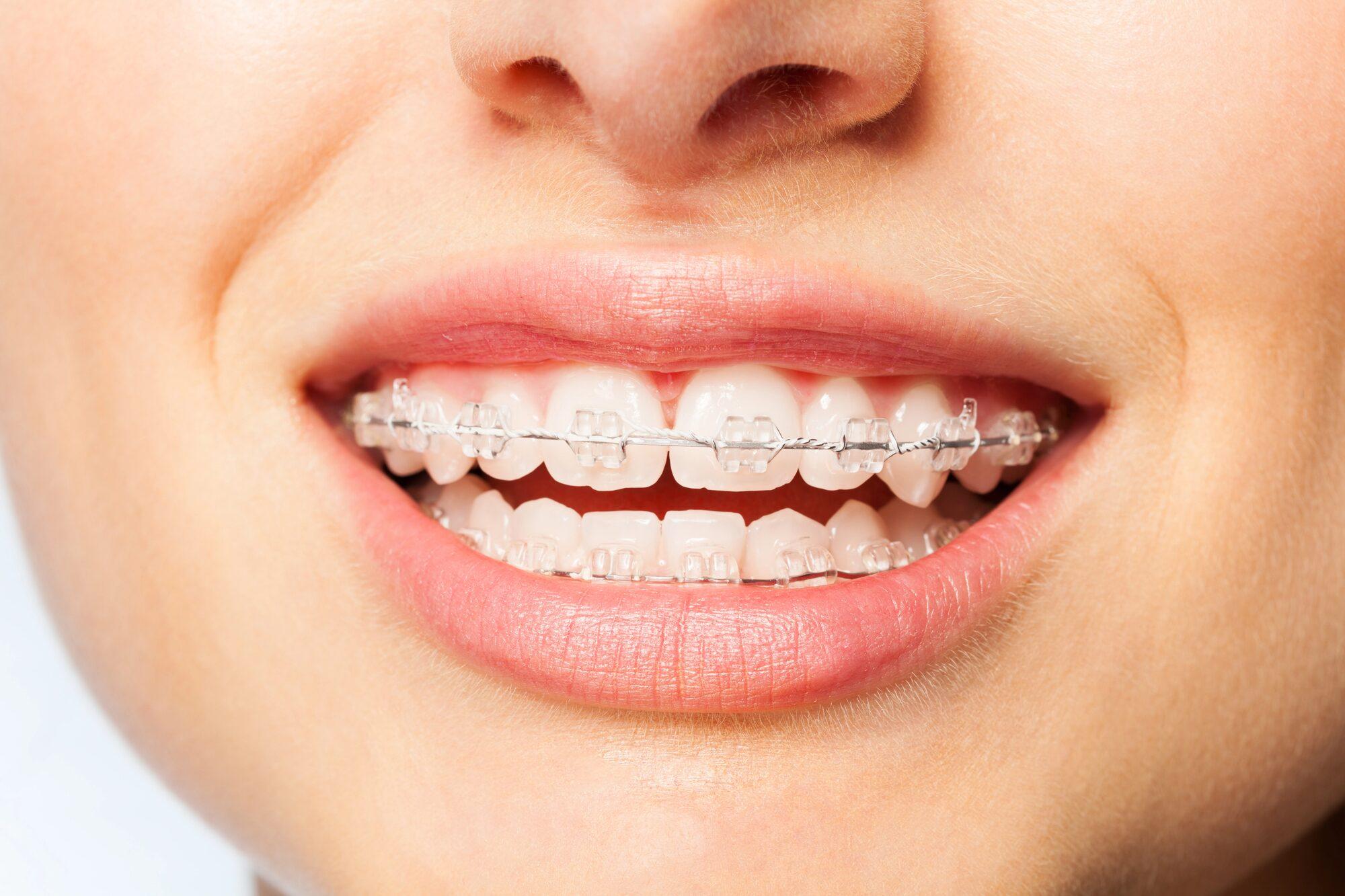 Fixed braces